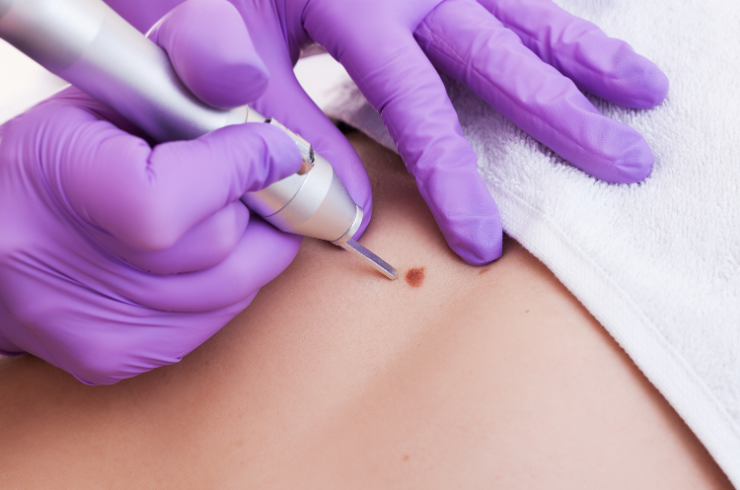Cosmetic Mole & Wart Removal