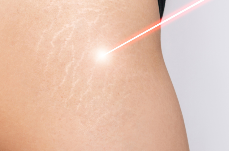 Laser Scar Reduction
